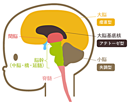 脳性麻痺とは どんな症状なの いつ分かるの 治療方法はあるの など徹底解説します Litalico発達ナビ