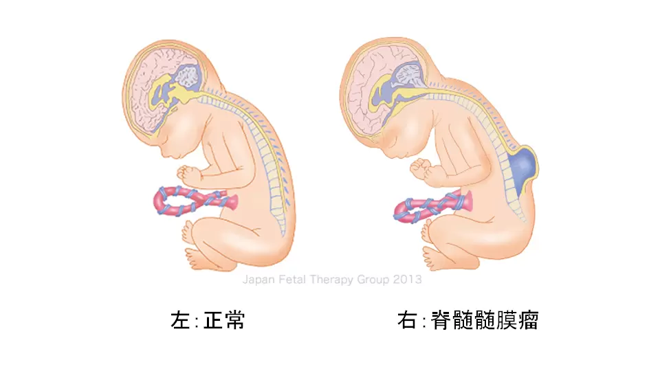 二分脊椎とは？どんな原因・症状なの？葉酸で予防できる？遺伝との関連