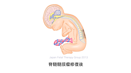 二分脊椎とは どんな原因 症状なの 葉酸で予防できる 遺伝との関連は Litalico発達ナビ