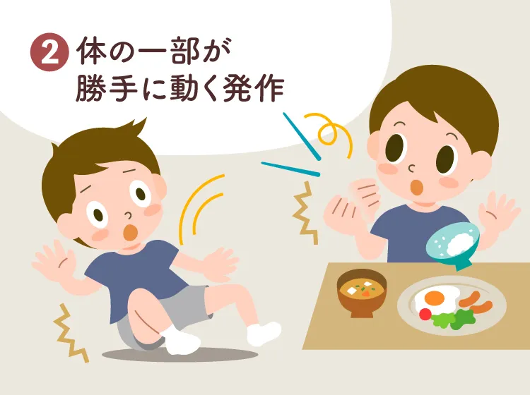 てんかん発作の種類2：体の一部が勝手に動く発作（さくらキッズくりにっく院長・小児科医・藤井明子先生監修） 

