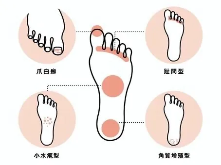 放課後等デイサービス暖母/身近な水虫👣